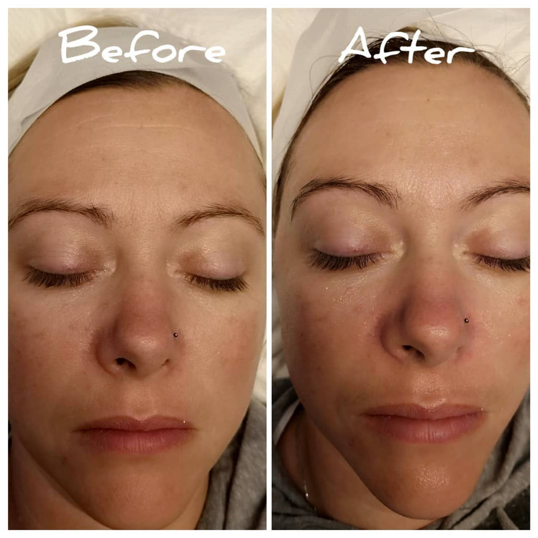 2 Facelift & Tightening Services
